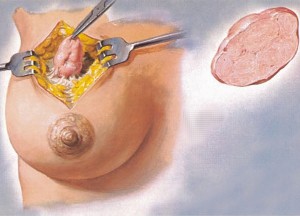 операция мастопатия