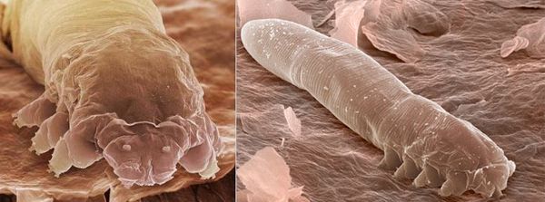 Клещ демодекс (Demodex folliculorum)