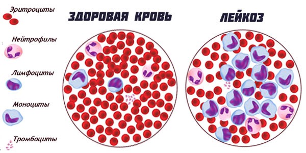 лейкоз крови
