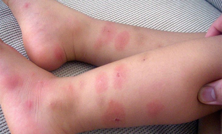 Аллергия на укус насекомых