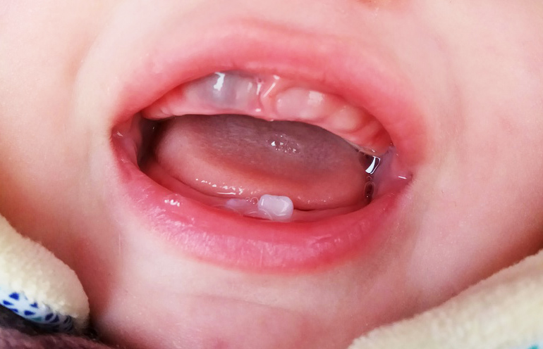 Почему у ребенка чернеют зубы?