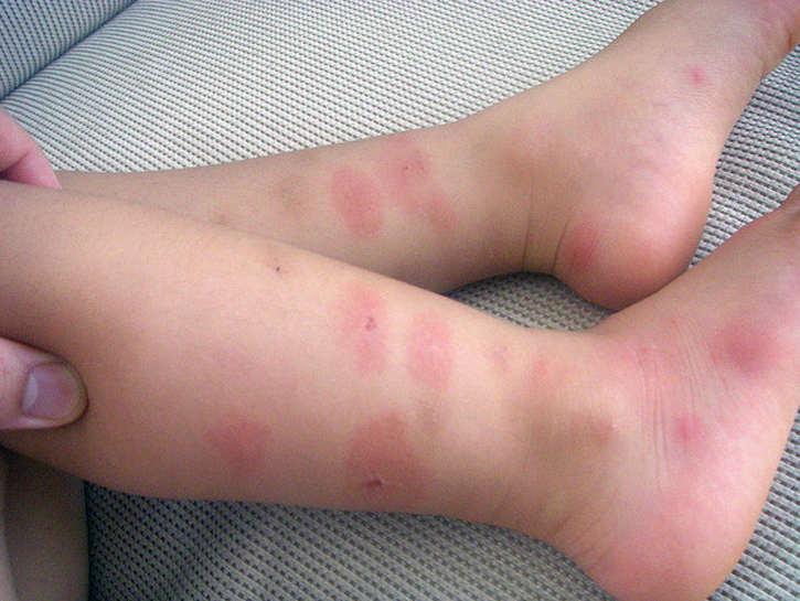 Аллергическая реакция на укус вредителя на теле ребенка