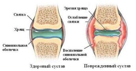 схема коленного сустава