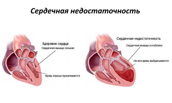 Сердечная недостаточность - одно из последствий боррелиоза