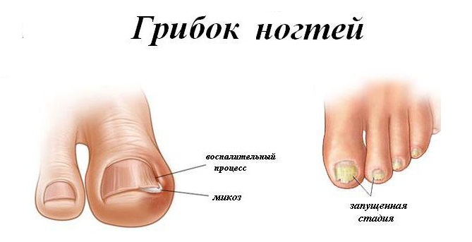 Причины грибка ногтей
