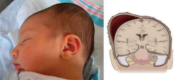 Гематома на голове у новорожденного