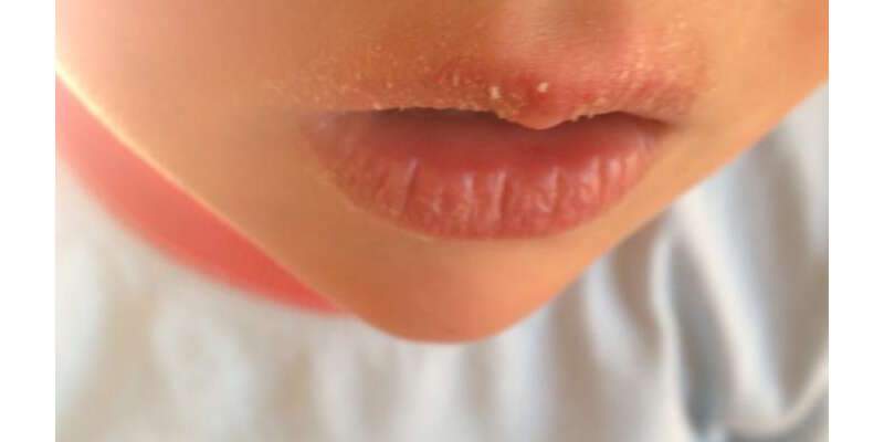 Признаки анемии у ребенка