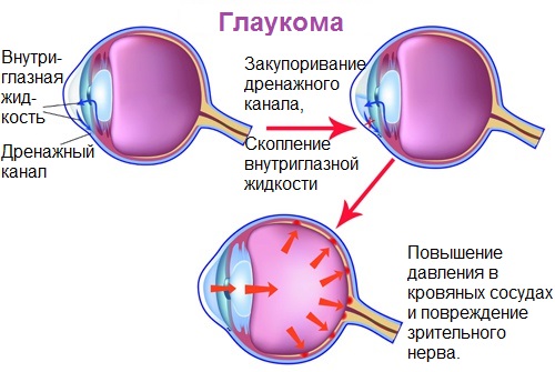 Проявления глаукомы