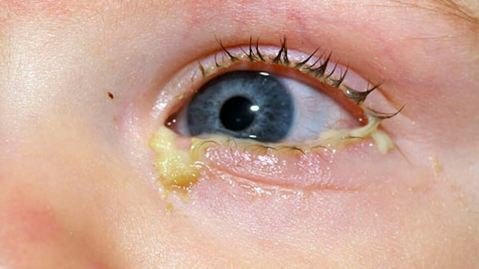 Как помочь малышу при нагноении глаз?