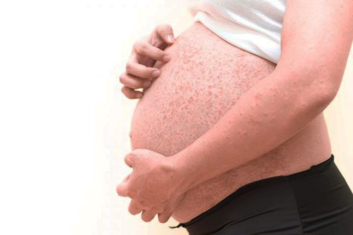 Чем опасна краснуха для беременных?