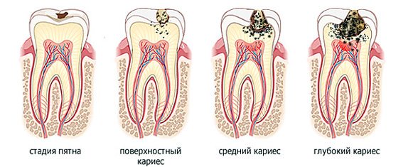признаки кариеса зубов 
