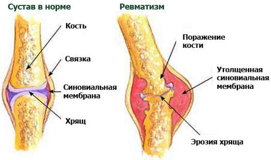 Признаки ревматизма у детей