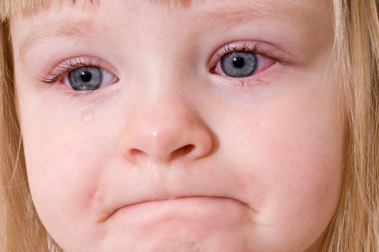 Как помочь малышу при нагноении глаз?